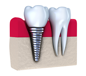 Dental Implants <a href="tel:+1-718-601-0100">(718) 601-0100</a>